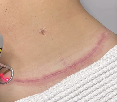 SkynReverse C-Section Scar Reduction